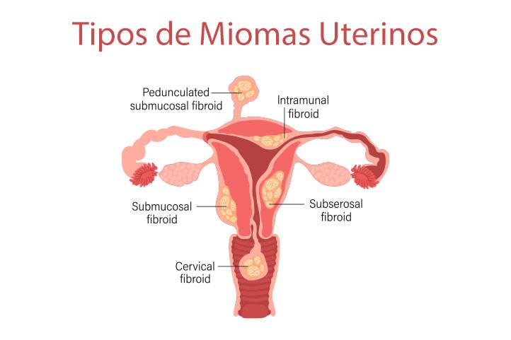 Miomas uterinos causam infertilidade