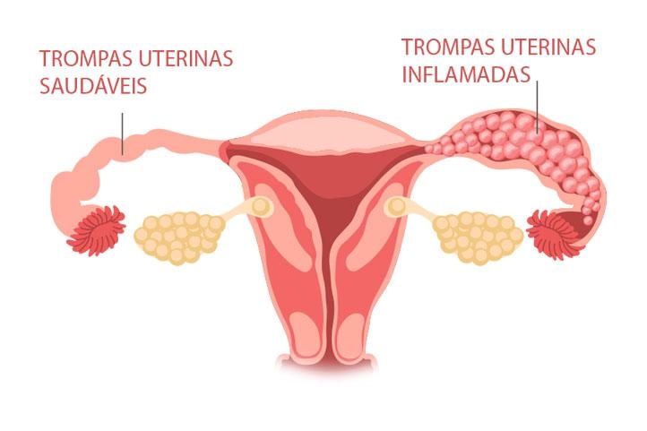 Hidrossalpinge interfere na fertilidade?