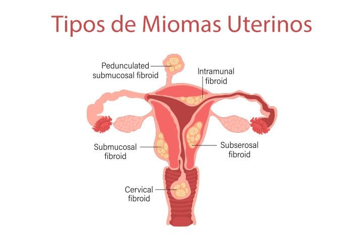 Miomas uterinos afetam a fertilidade da mulher?