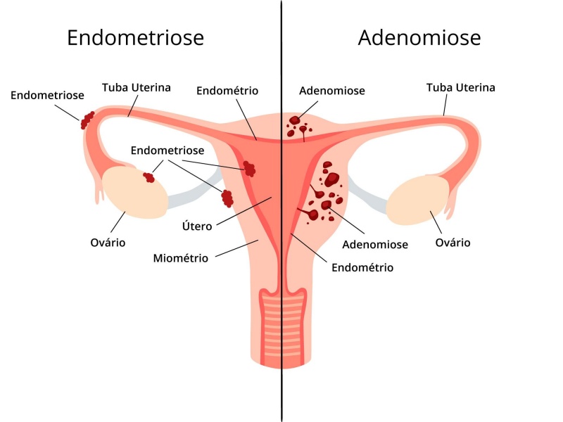 Qual a diferença entre Adenomiose e Endometriose?